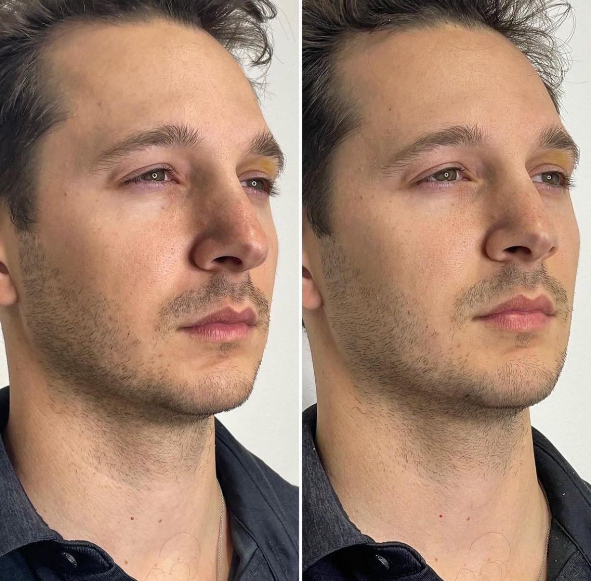 https://www.theperfectdose.com/wp-content/uploads/2024/10/Jawline-Filler-bxa.jpg